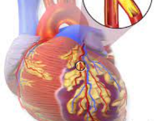 क्‍या हैं हृदयघात के लक्षण