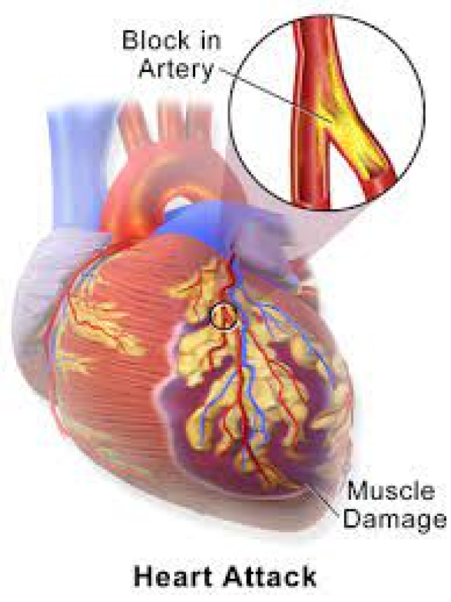 what signs symptoms heart stroke in hindi |हृदयघात के लक्षण -2023